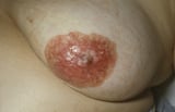 Breast cancer gene mutation