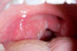 Tonsillar Cellulitis and Tonsillar Abscess
