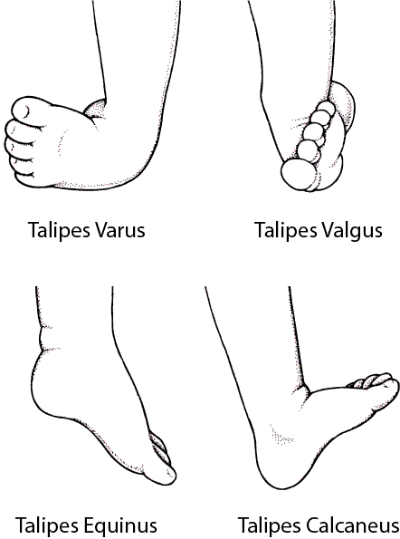 Common Types of Clubfoot