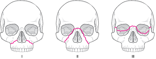 Le Fort Classification of Midface Fractures