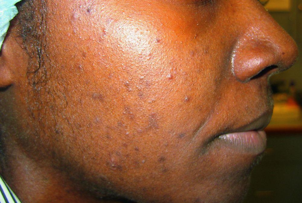 Acné inflammatoire avec hyperpigmentation