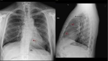 Radiographie pulmonaire d'un patient après un pontage aortocoronarien