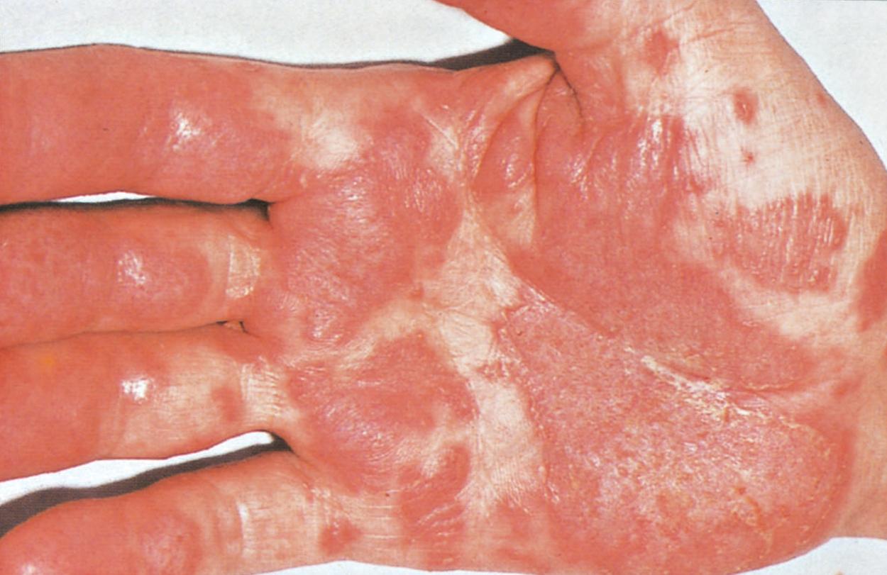 Cheratoderma blenorragico del palmo della mano
