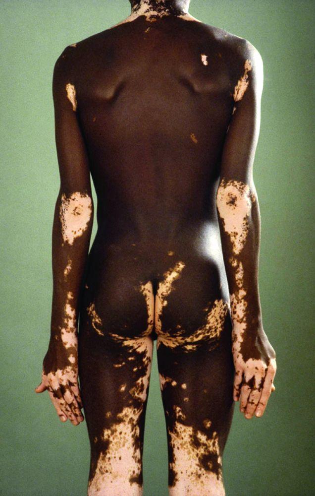 Vitiligo contrastant avec une peau foncée