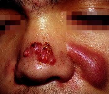 Abscesos como consecuencia del acné