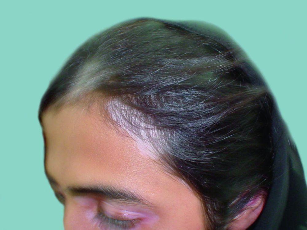 Vitiligo avec dépigmentation des cheveux