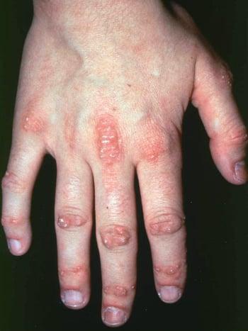 피부근육염의 손 증상