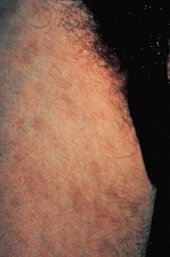 Голубовато-серые точки вследствие укусов лобковых вшей