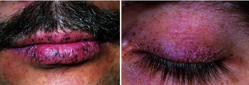 Macchie nero-bluastre sulla pelle e sulle labbra (sindrome di Peutz-Jeghers)