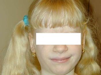 Albinisme (symptômes cutanés)