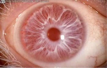 Albinismus (Augensymptome)