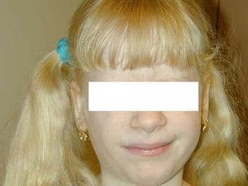 Albinismo (sintomi cutanei)
