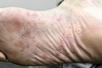 Palmoplantare Psoriasis an der Fußsohle