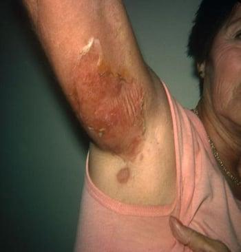 Síndrome de la piel escaldada por estafilococos (adultos)