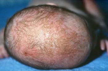 Seborrheic Dermatitis (Cradle Cap)