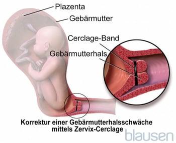 Zervixcerclage