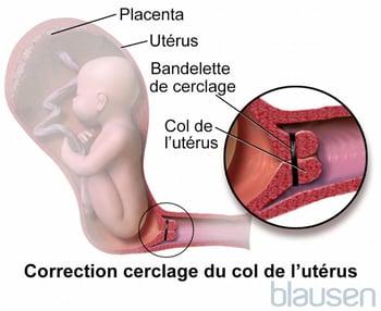 Cerclage du col de l’utérus