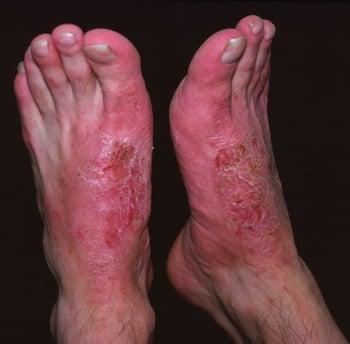 Contact Dermatitis (Feet)