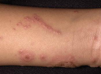 Dermatitis de contacto alérgica