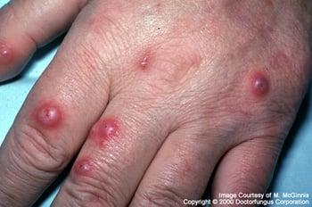 Cryptococcosis That Spreads to the Skin