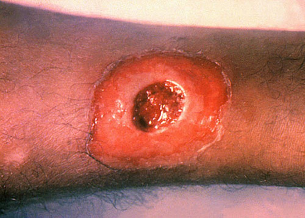 Открытая язва, возникшая в результате дифтерии кожи