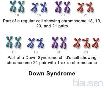 Sindrome di Down: trisomia 21