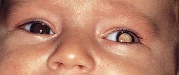 網膜芽細胞腫がある乳児の白色瞳孔