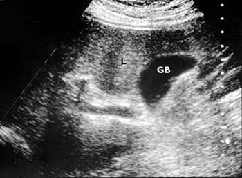 Ultrassonografia do fígado e da vesícula biliar