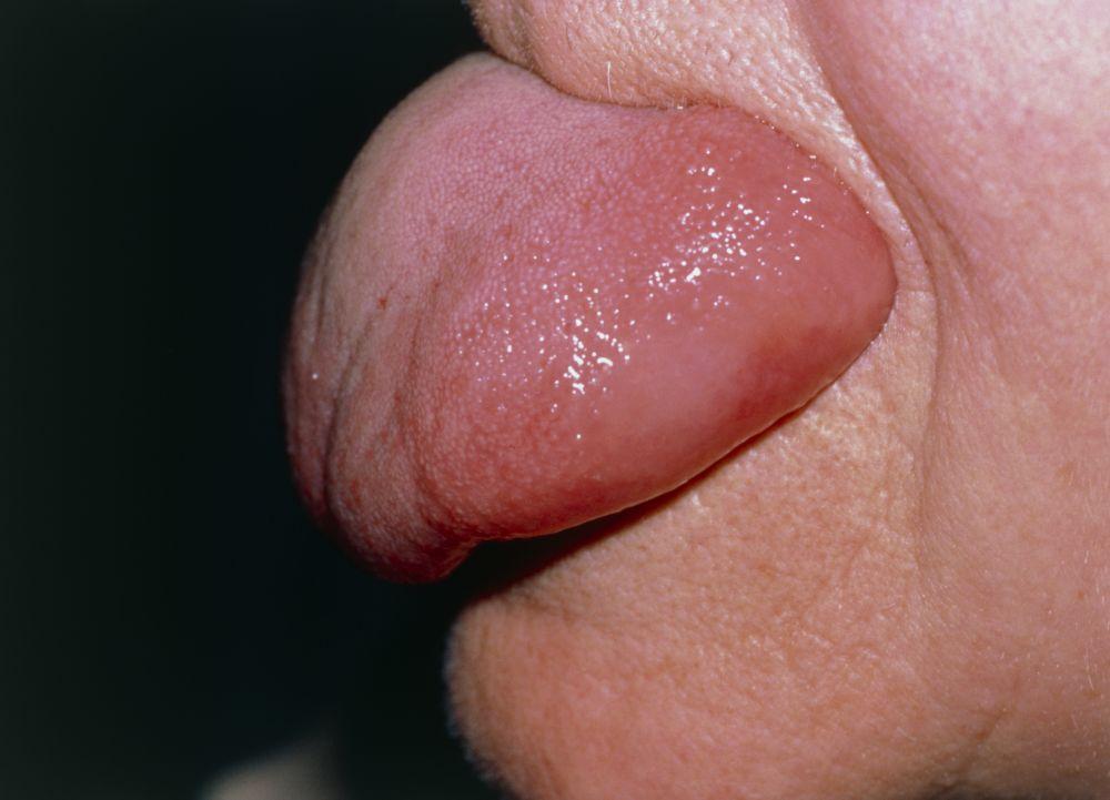 舌の血管性浮腫