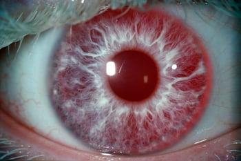 Albinismo (sintomi oculari)