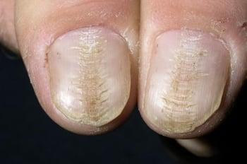 Срединная дистрофия ногтей