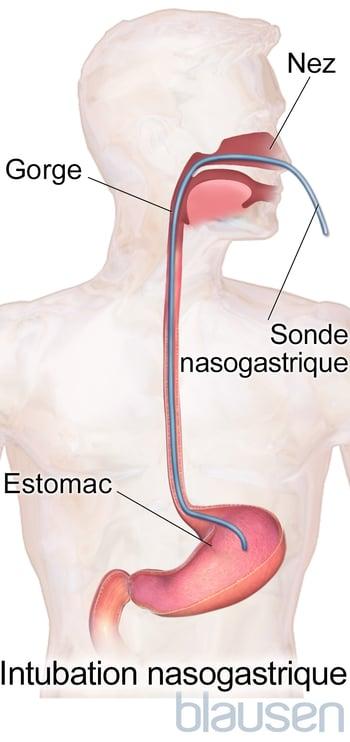 Intubation nasogastrique
