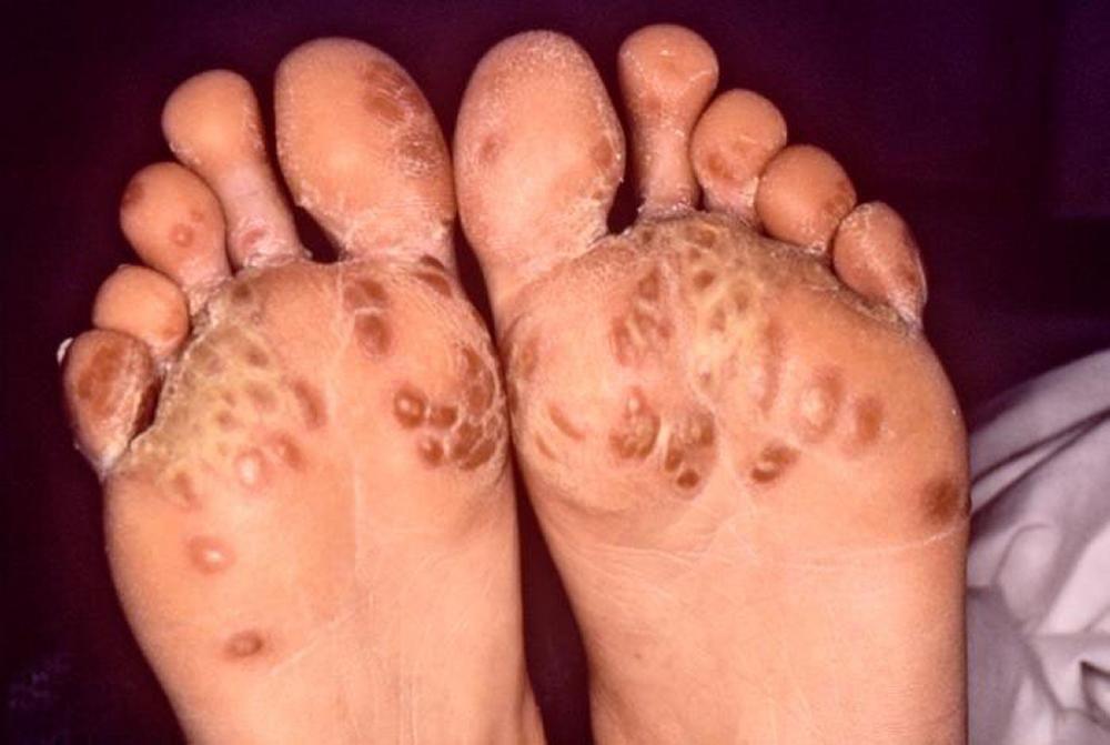 Arthrite réactionnelle touchant les pieds