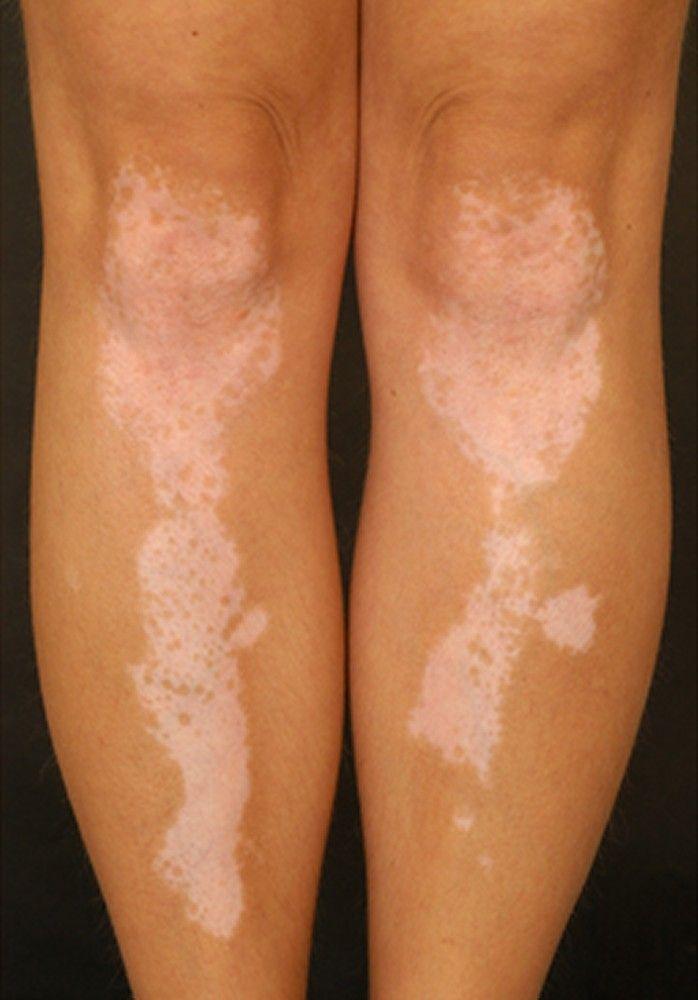 Symmetric Vitiligo on the Legs