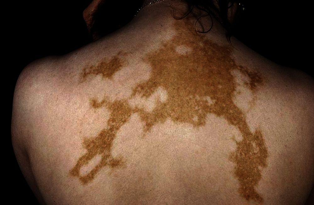 Vitiligo universel sur le dos