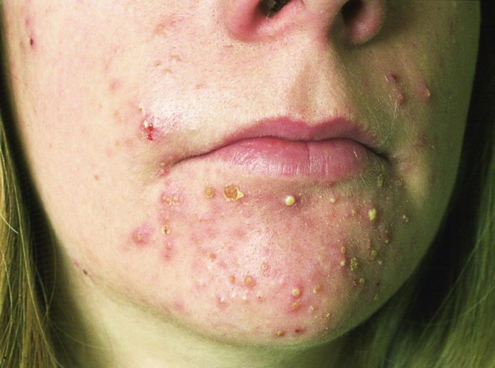 Acne With Multiple Pustules