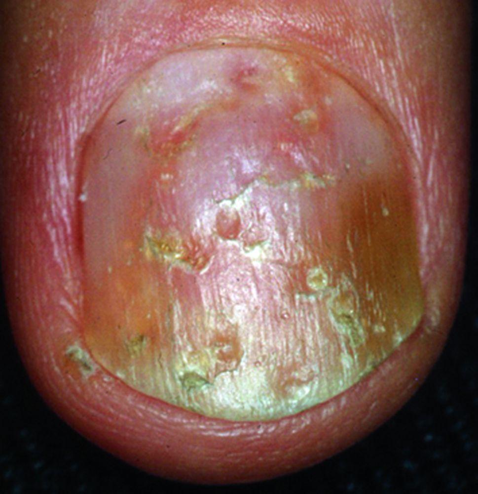 Psoriasis des ongles avec anomalie de coloration et taches