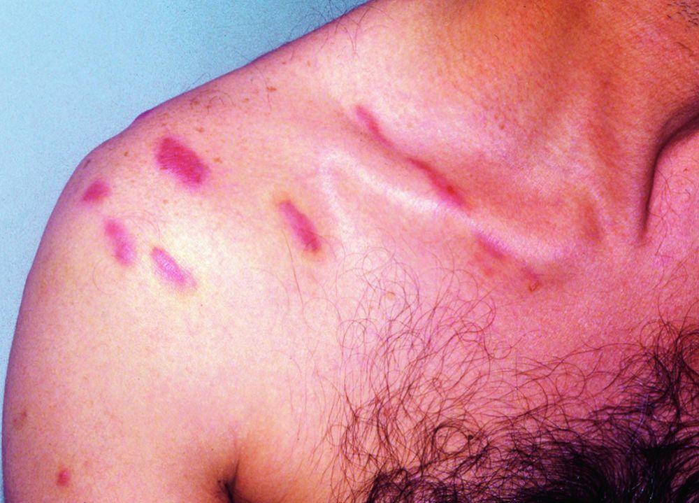 Sarcoma de Kaposi (hombro)