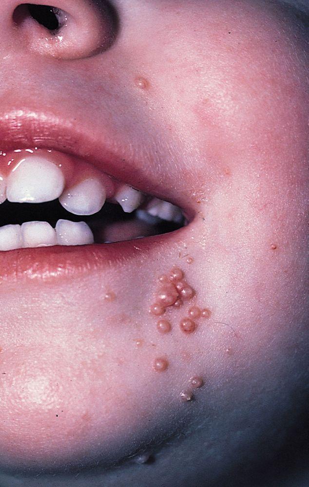 Molluscum contagiosum sur le visage d'un enfant