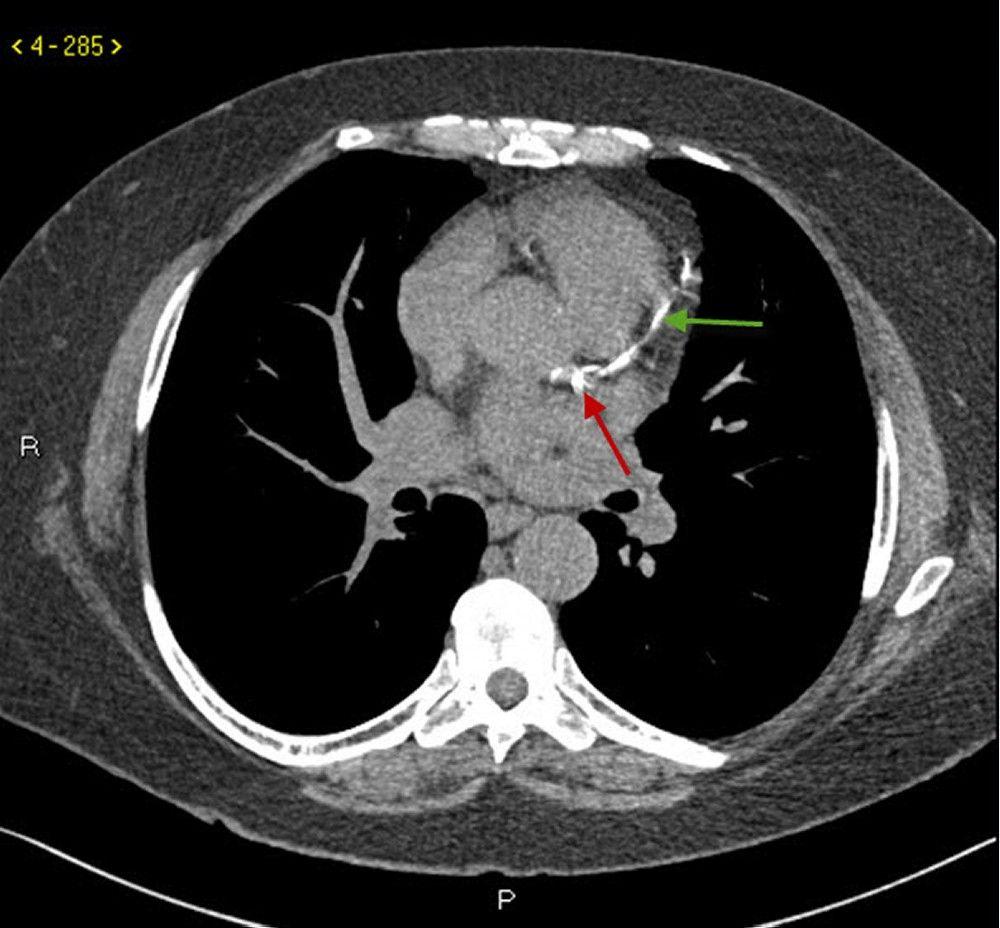 Noncontrast CT Showing Coronary Artery Calcification