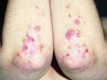 Dermatitis Herpetiformis on the Elbows
