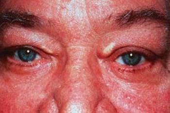 Xanthelasma of the Eyelid