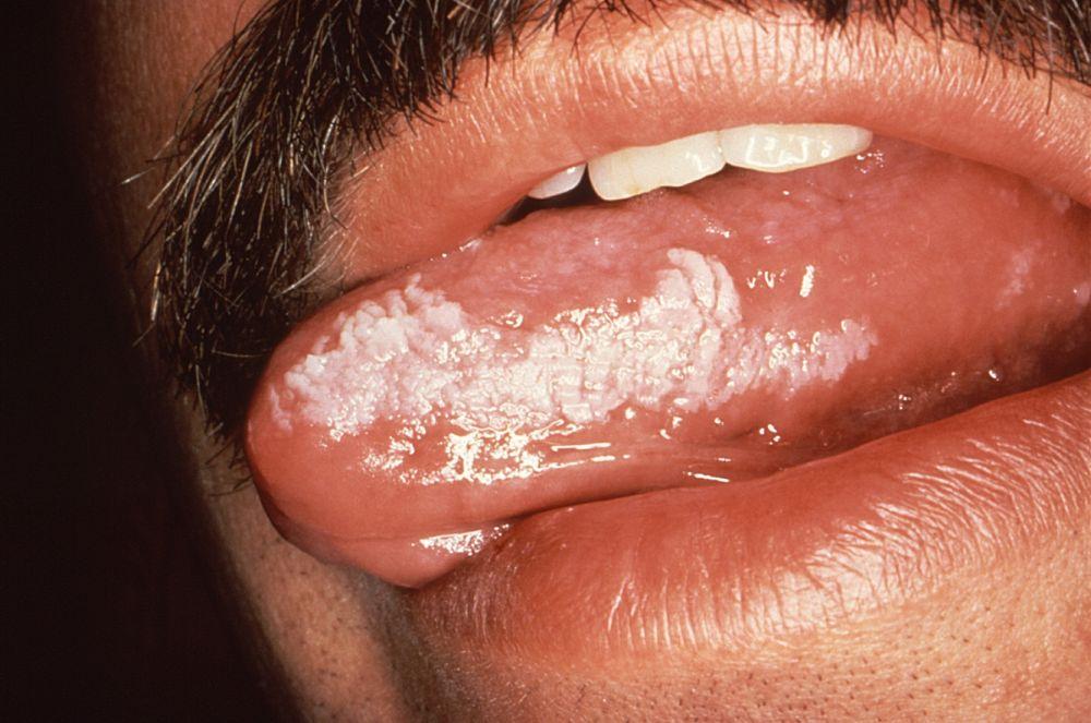 Leucoplasia vellosa oral