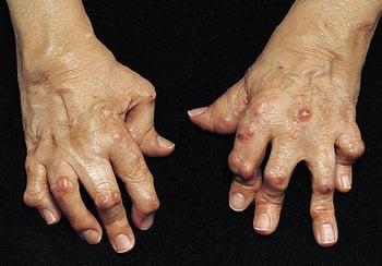 Deformidad en ojal en la artritis reumatoidea
