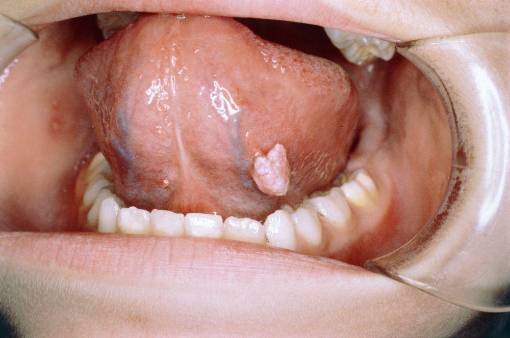 Papiloma escamoso de la lengua