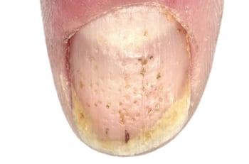 Piqués des ongles causés par une arthrite juvénile idiopathique psoriasique