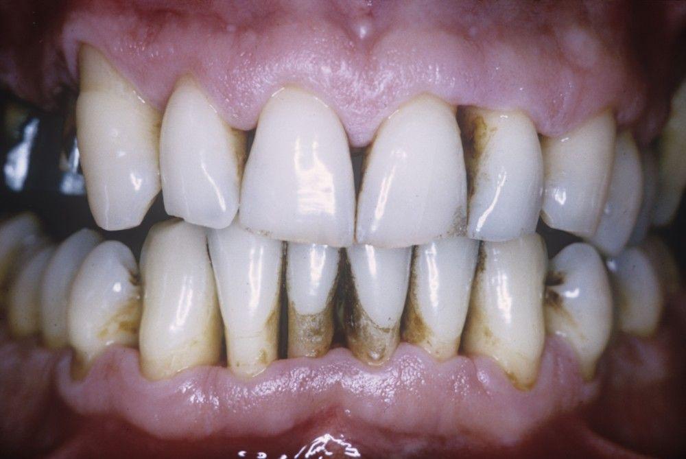 Periodontitis (Loss of Supporting Tissues of the Tooth)