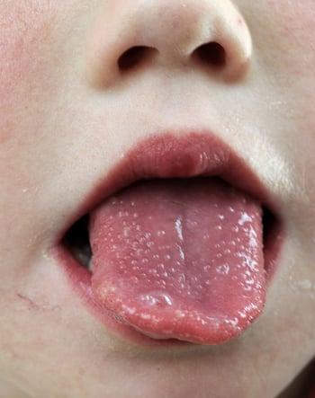 Langue fraise ou framboisée (enfant)