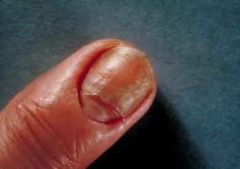 Candidiasis (Nail Infection)