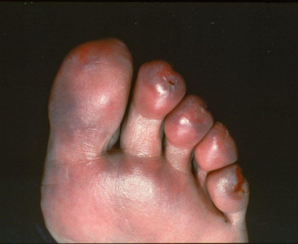 Sabañones (perniosis) (dedos de los pies)
